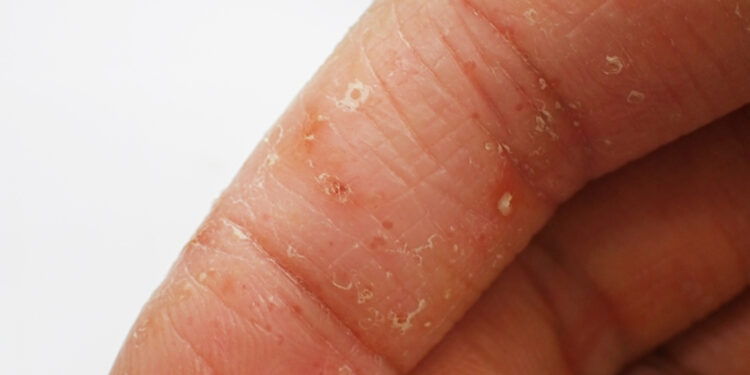 Dishidrotinė egzema (dishidrozė): simptomai, priežastys, gydymas