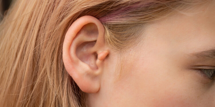 Ausų deformacijos: tipai, priežastys ir gydymas