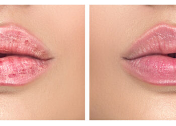 Burna išsausėjimas (xerostomija): priežastys, simptomai ir gydymas