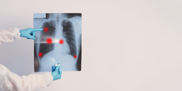 COVID-19 sukelta plaučių žala: simptomai, randėjimas ir galimos ligos