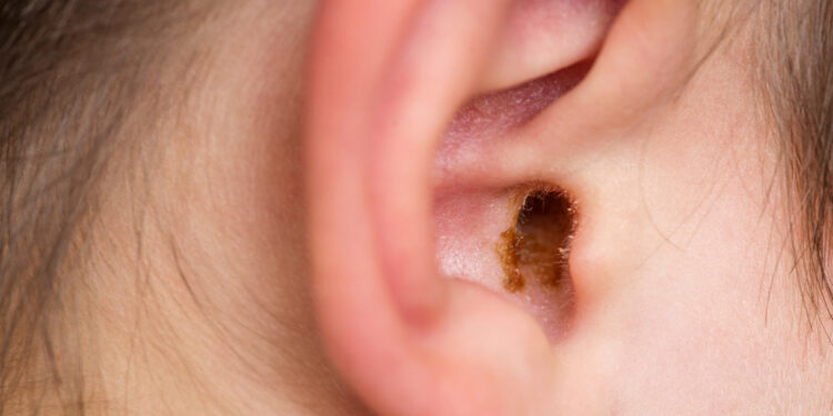 Ausų sieros kamštis: simptomai, priežastys ir šalinimas