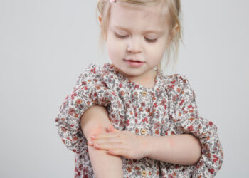 10 paprastų veiklų vaikui egzemos paūmėjimo metu