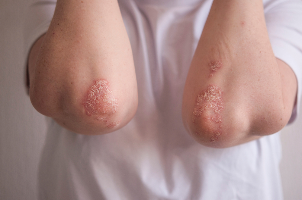 Psoriazinio artrito savipriežiūra: 6 žingsnių gidas