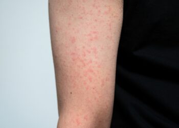 Daugiaformė raudonė: simptomai, priežastys ir gydymas