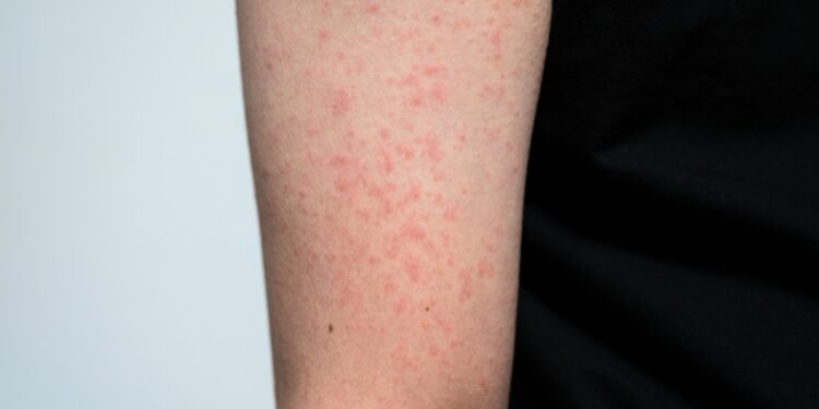 Daugiaformė raudonė: simptomai, priežastys ir gydymas