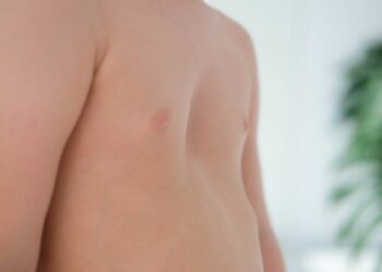 Krūtinkaulio kremzlės uždegimas: priežastys, simptomai, dažniausi klausimai ir gydymas