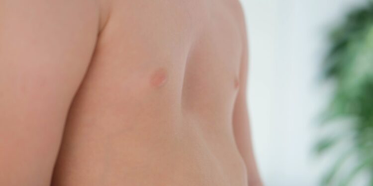 Krūtinkaulio kremzlės uždegimas: priežastys, simptomai, dažniausi klausimai ir gydymas