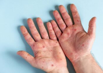 Enterovirusas D68: priežastys, simptomai ir gydymas