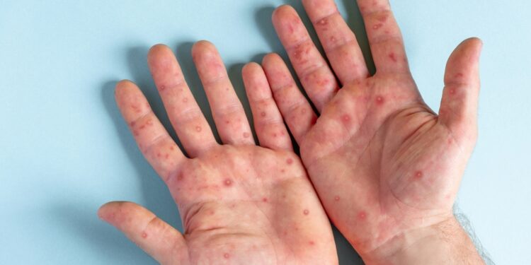 Enterovirusas D68: priežastys, simptomai ir gydymas