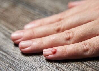 Eozinofilinė granuloma: simptomai, priežastys ir gydymas