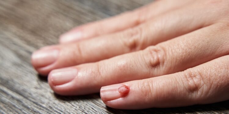 Eozinofilinė granuloma: simptomai, priežastys ir gydymas