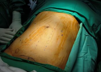 Epigastrinė išvarža: simptomai, priežastys, gydymas ir operacija