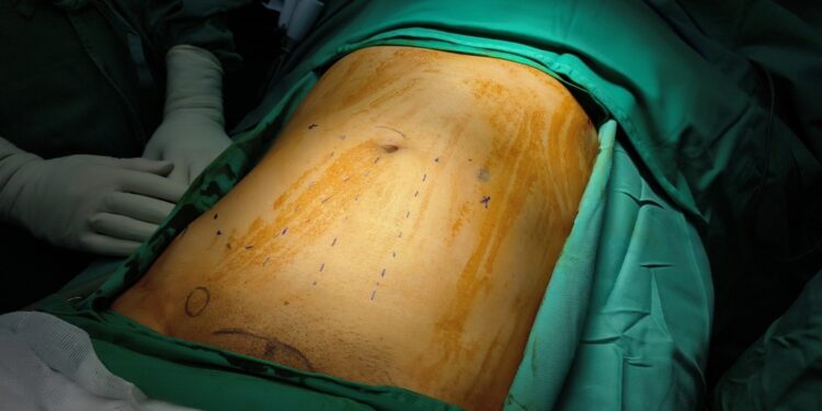 Epigastrinė išvarža: simptomai, priežastys, gydymas ir operacija