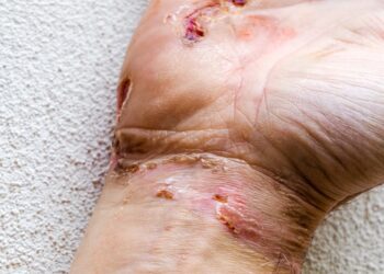 Pirmoji pagalba patyrus elektros smūgį arba sužalojimą elektra