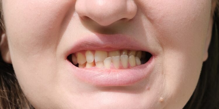 Išniręs žandikaulis: simptomai ir gydymas