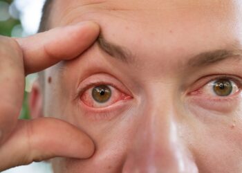 Ašarojančios akys (epifora): tipai, priežastys ir gydymas