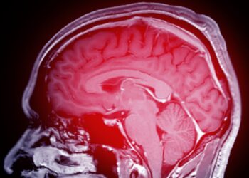 Embolinis insultas: kas tai, priežastys, simptomai ir gydymas