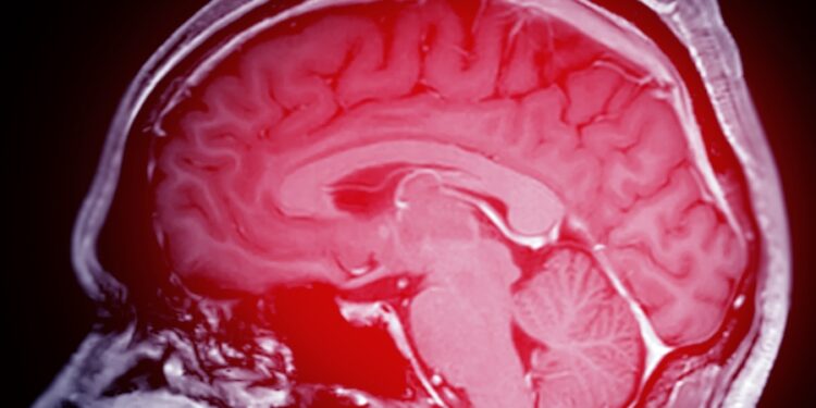 Embolinis insultas: kas tai, priežastys, simptomai ir gydymas