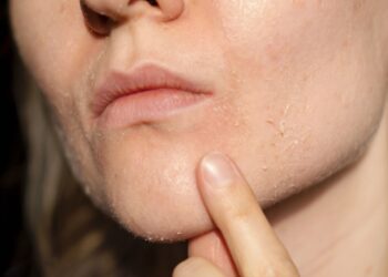 Sausa oda (kerodermija): simptomai, priežastys, gydymas ir profilaktika