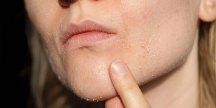 Sausa oda (kerodermija): simptomai, priežastys, gydymas ir profilaktika