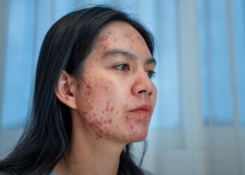 Cistinė aknė: kas tai, simptomai, priežastys ir gydymas