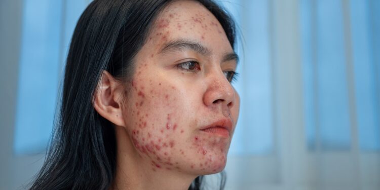 Cistinė aknė: kas tai, simptomai, priežastys ir gydymas