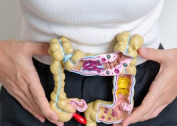 Divertikuliozė: kas tai, simptomai, priežastys ir gydymas