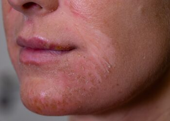 Egzema veide: simptomai, priežastys, tipai ir gydymas