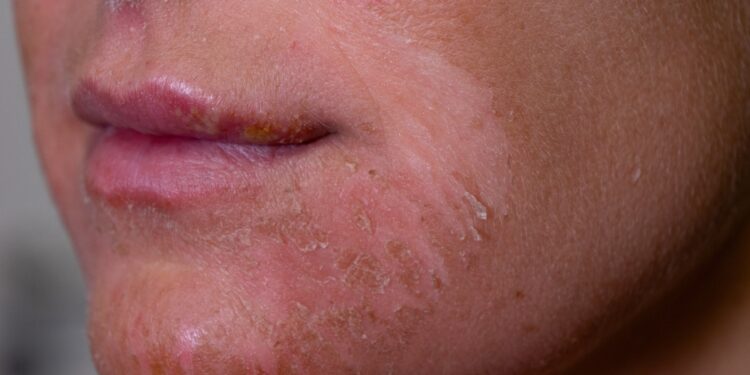 Egzema veide: simptomai, priežastys, tipai ir gydymas