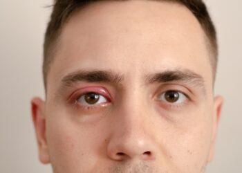 Entropionas: simptomai, priežastys, gydymas ir operacija