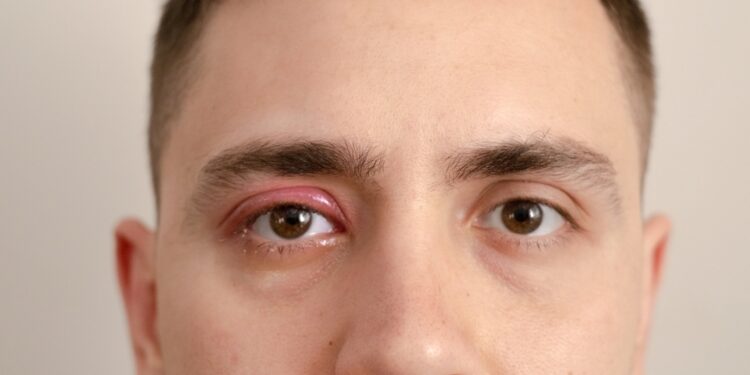 Entropionas: simptomai, priežastys, gydymas ir operacija