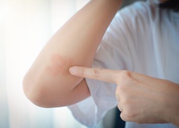 Žmonės kaip aš: Kaip gyventi su psoriaziniu artritu