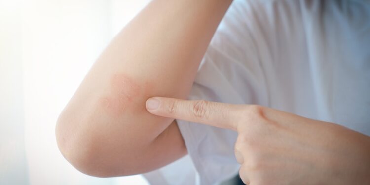 Žmonės kaip aš: Kaip gyventi su psoriaziniu artritu