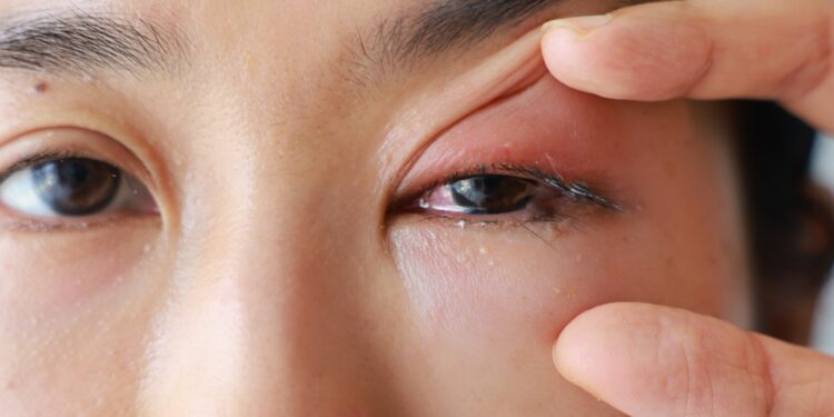 Endoftalmitas: priežastys, simptomai ir gydymas