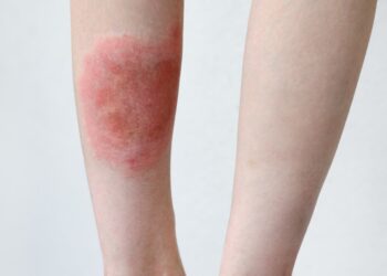 Mazginė eritema: simptomai, priežastys ir gydymas