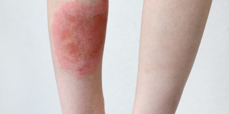Mazginė eritema: simptomai, priežastys ir gydymas