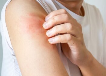 Kaip progresuoja (vystosi) psoriazė?