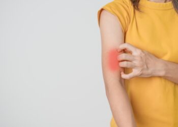 Diskoidinė raudonoji vilkligė: kas tai, priežastys, simptomai ir gydymas