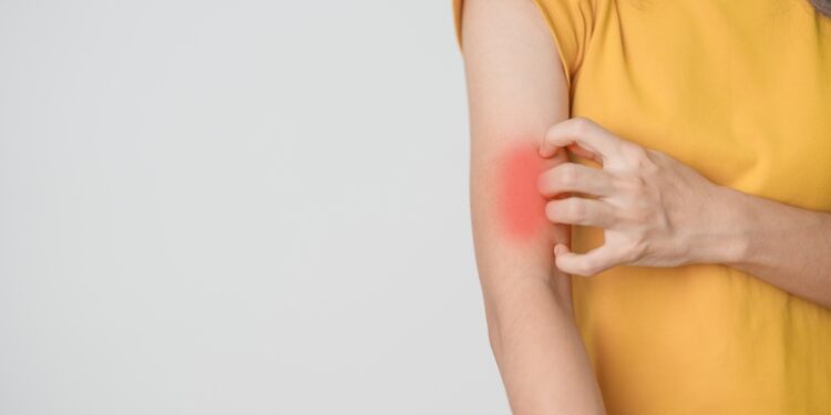 Diskoidinė raudonoji vilkligė: kas tai, priežastys, simptomai ir gydymas