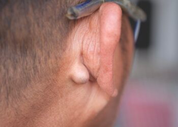 Ausų navikai: simptomai, rūšys ir gydymas