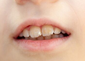 Dentinogenezės imperfekcija: tipai, simptomai ir gydymas