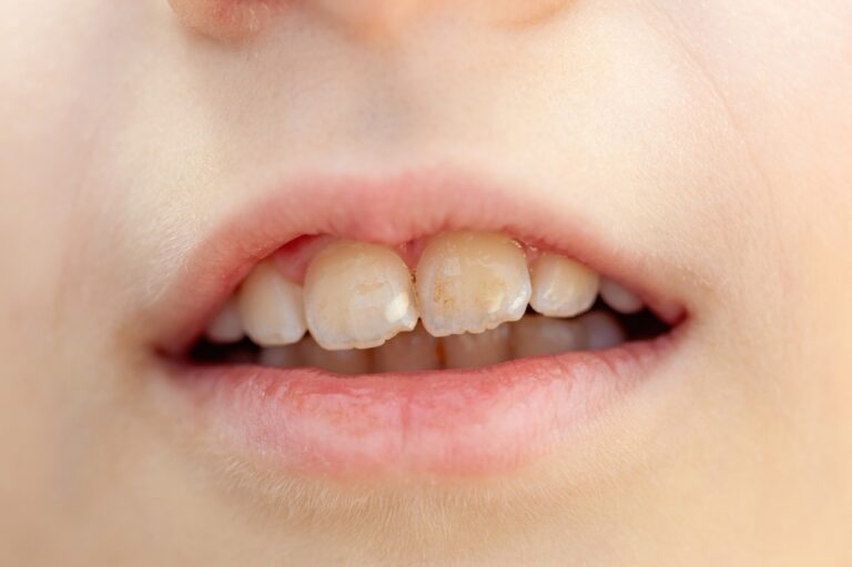 Dentinogenezės imperfekcija: tipai, simptomai ir gydymas