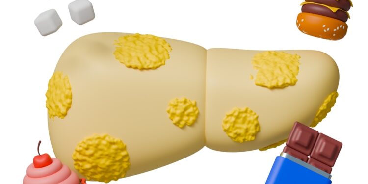 Kaip progresuoja nealkoholinė suriebėjusi kepenų liga?