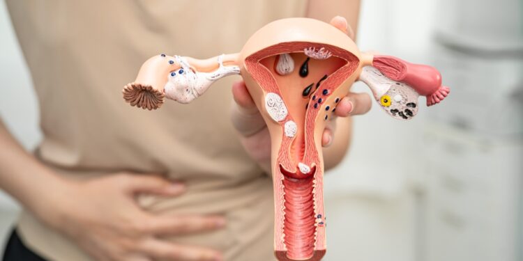 Endometritas: priežastys, simptomai, diagnostika ir gydymas