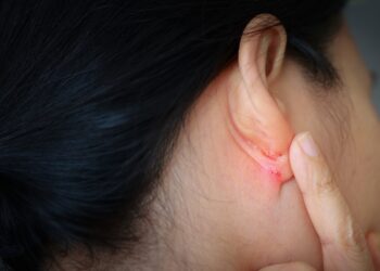 Ausų egzema: simptomai, priežastys ir gydymas