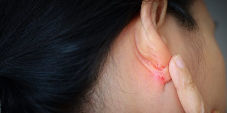 Ausų egzema: simptomai, priežastys ir gydymas