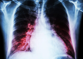 Padidėjusi širdis (kardiomegalija): kas tai, simptomai ir gydymas