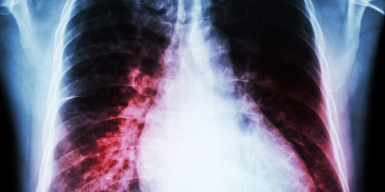 Padidėjusi širdis (kardiomegalija): kas tai, simptomai ir gydymas