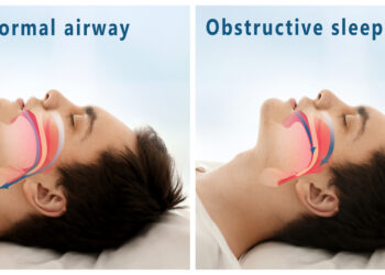 Epiglotitas: simptomai, priežastys ir gydymas