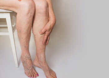 Edema: Priežastys, simptomai ir gydymas